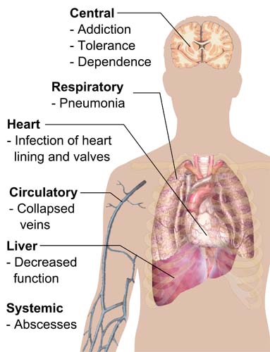 Heroin Addiction - the long-term impact - depiction of heroin addiction on the central, respiratory, heart, circulatory, liver and systemic systems of the human body